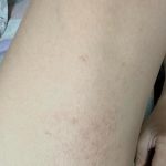 Nấm Thỏ lây sang Người: Nguyên nhân, Cách phòng tránh và điều trị