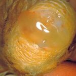 ĐIỀU TRỊ GÀ BỊ SƯNG CHÂN